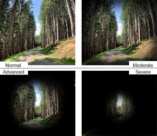 Four Stages of Glaucoma